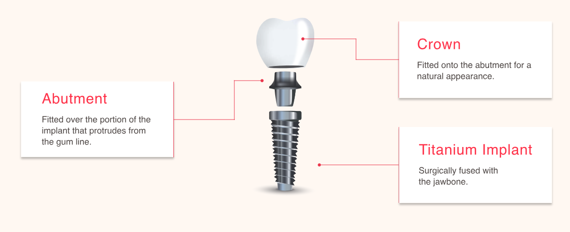 implant-graphic